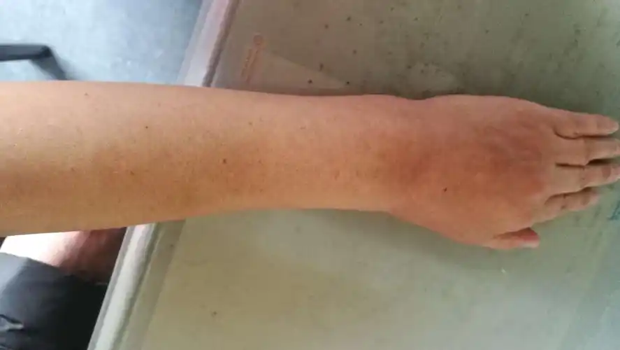 寻压痛点持续微痛刺激过程及效果