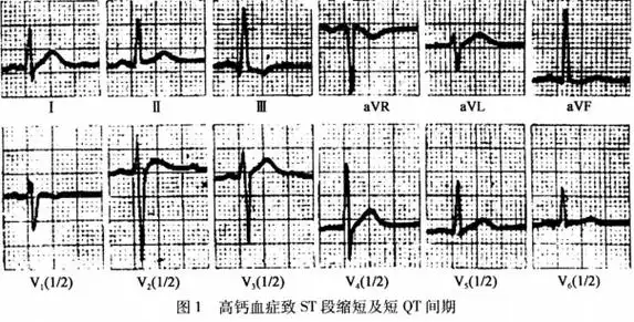 高钙血症心电图解读
