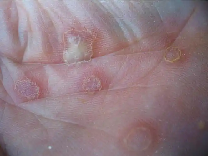 硬下疳初期图片8