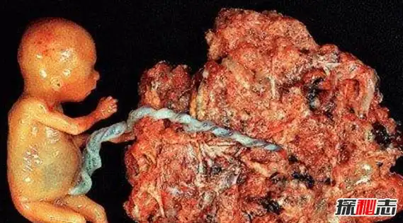 葡萄胎是什么原因造成的(六个因素)