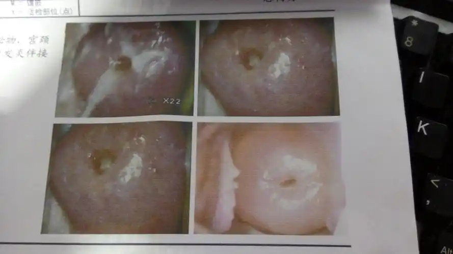 附件:我想知道我这是不是宫颈炎,是宫颈糜烂,囊肿,息肉还是什么的,想