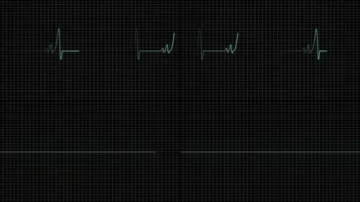 心电图跳到停止视频素材