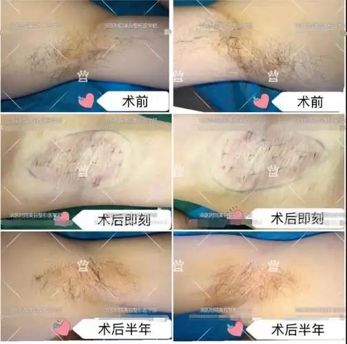 中华医药慢性湿疹治疗偏方_治疗慢性荨麻疹偏方_慢性扁