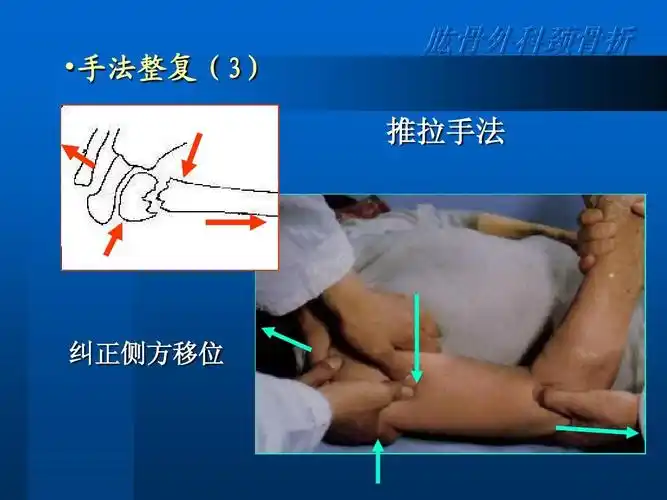 尺骨鹰嘴骨折ppt