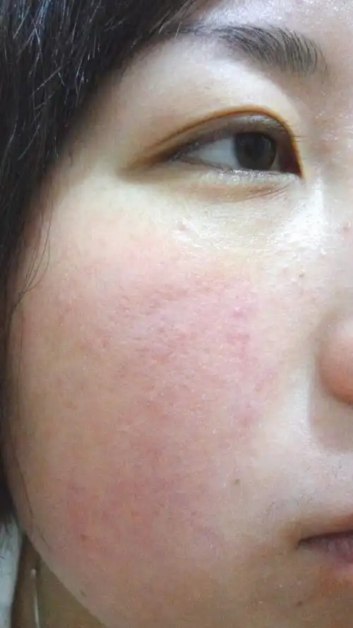 我的脸怎么才能好啊脸一直过敏,怎么办,脸上有红血丝 | 妈妈网轻聊