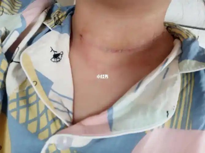 甲状腺术后17天啦