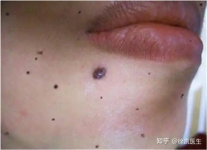 脸上的黑痣可以随便去掉吗