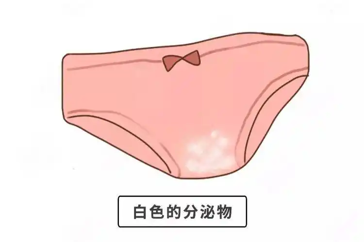 76白色分泌物"五颜六色"的分泌物,暗藏啥问题?