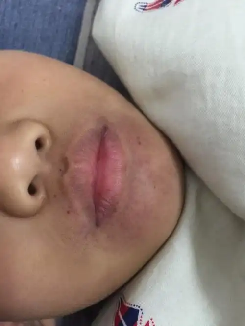 孩子嘴边周围都是红紫色,还有紫色的点点,这是怎么了?