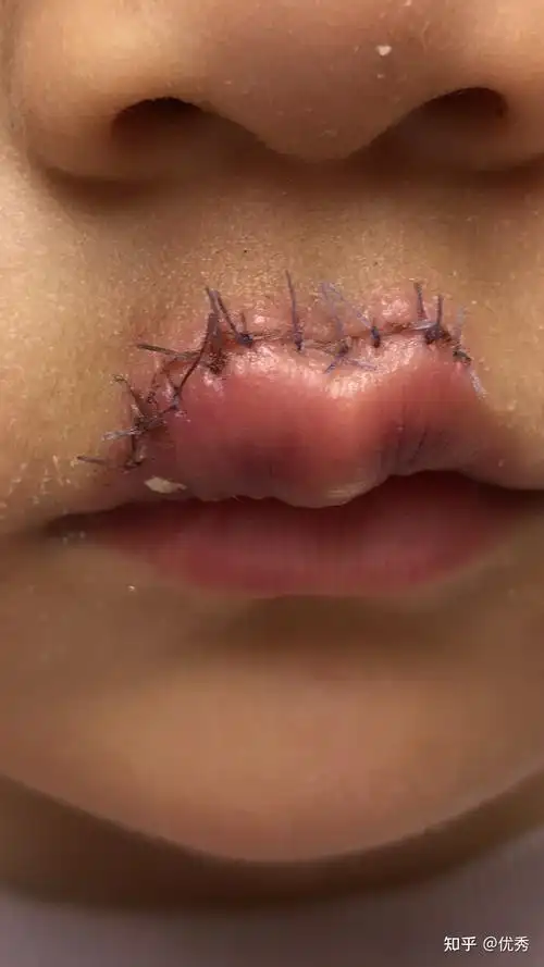 女儿嘴巴缝了13针