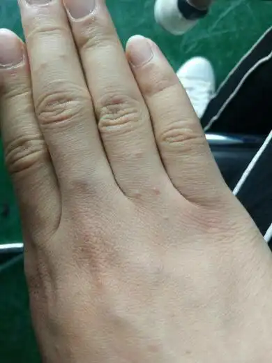 这手上小疙瘩是什么情况