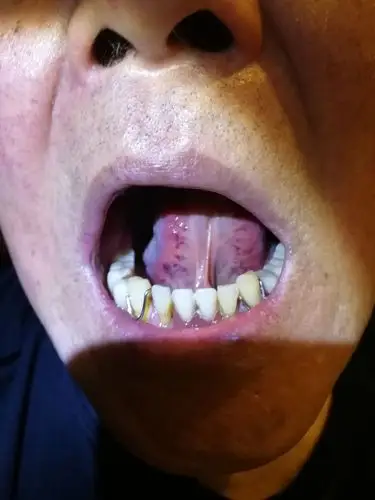 舌下静脉有血淤,泻三焦火必用栀子