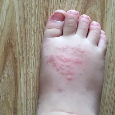 宝宝脚上长了什麼.怎麼回事?