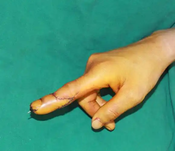 手指再植适用于哪些情况?拇指离断要如何再植?