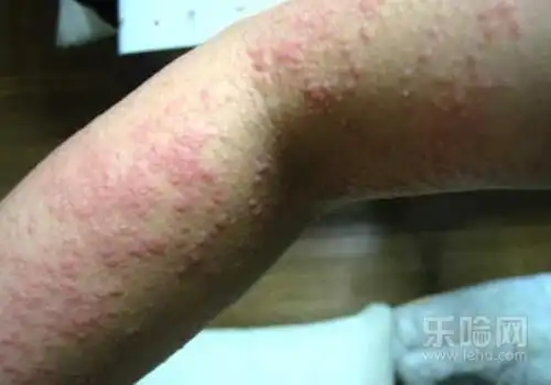 湿疹有几种类型和图片