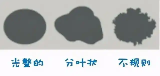 有的结节边缘是光整的,有的结节边缘呈分叶状,有的结节边缘非常不规则