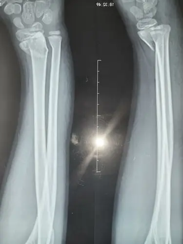 摄片显示骨折,移位明显