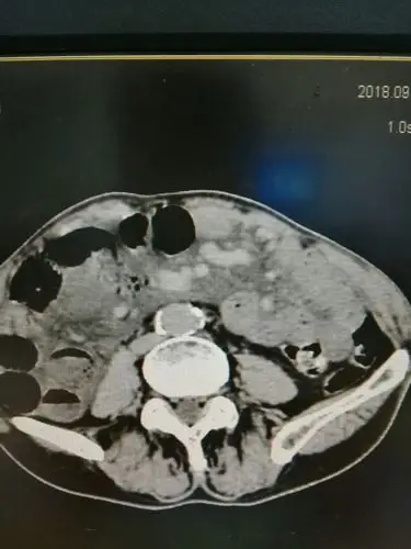 我院ct室诊断首例 高漏诊危急重症病例～～～～肠系膜动脉栓塞