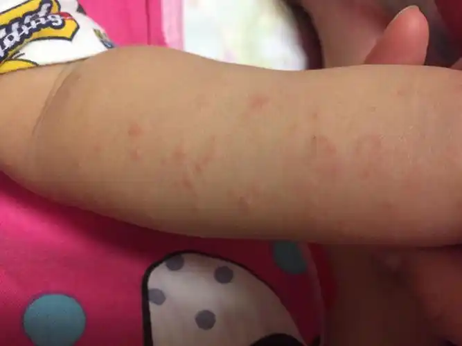 宝宝胳膊上起的是湿疹还是过敏了