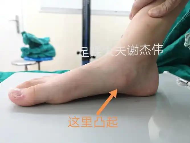足内侧骨凸起,一旦扭伤了长期疼痛,这是为什么?
