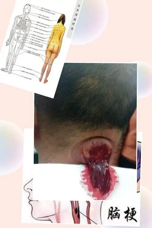 贝瑞德商学院一排瘀疗法学习