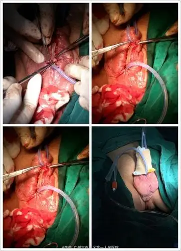 尿道下裂术后尿瘘,尿道狭窄