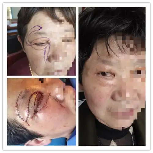 眼睑巨大睑黄瘤切除 带蒂皮瓣转移修复术