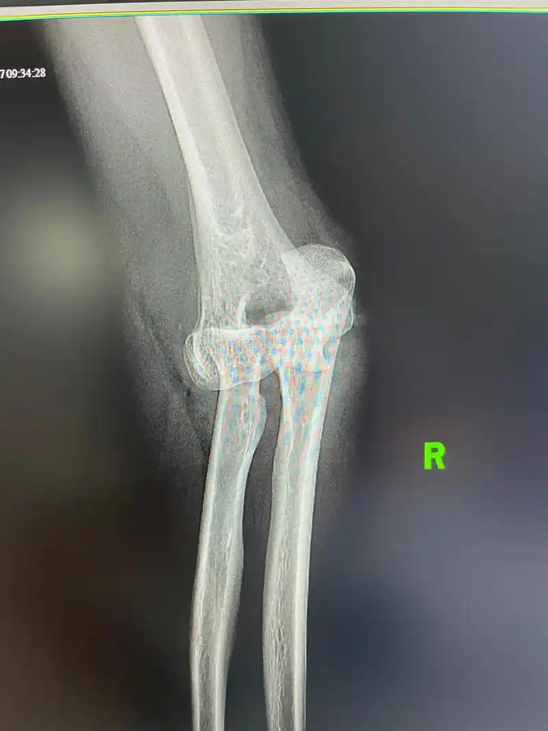 医学影像 肘关节脱位,闭合复位.看看还有什么问题? - 抖音