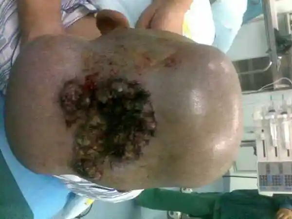 无 疼痛 及其他不适,查体:头顶部皮肤约8*9cm肿块,高于头皮1～1