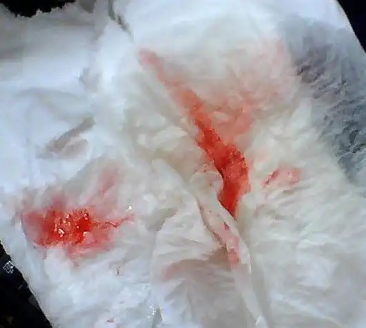 肺癌晚期都是拖出来的3种咳嗽要重视早做检查会更好