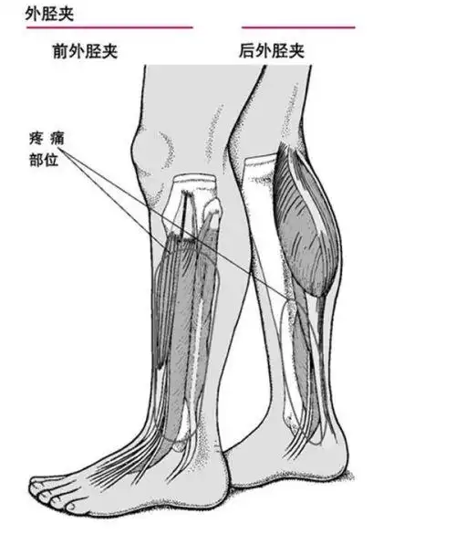 快走后小腿外侧肌肉酸痛,怎么回事