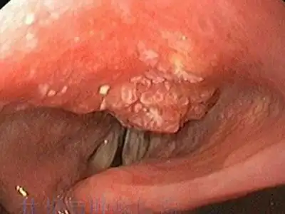 医学专家是如何看待喉肿瘤的?