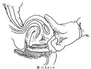 【抽吸刮宫术】抽吸刮宫术手术详细步骤,抽吸刮宫术手术过程_百姓健康