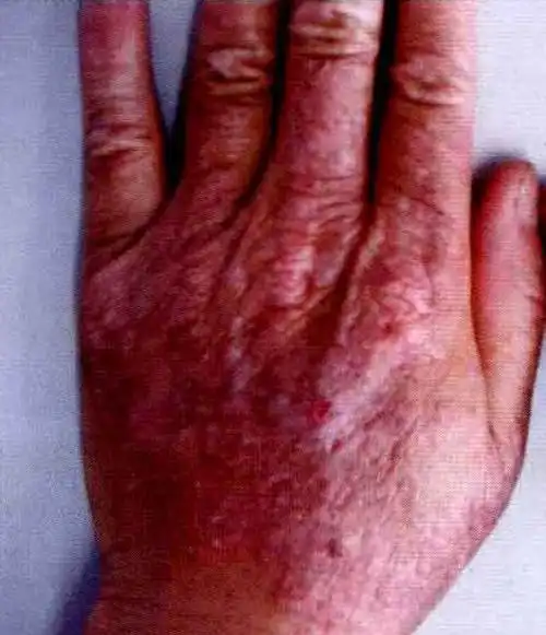 村医学习最全常见皮肤病图谱附口服外用联用药