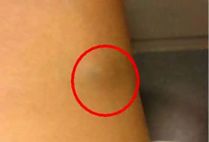 脂肪瘤手术后多久恢复割5cm脂肪瘤要多少钱