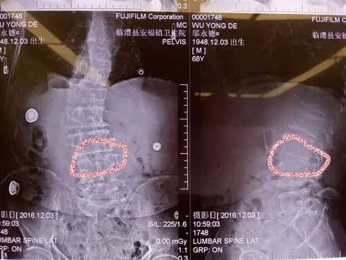 术前检查:x线 腰椎侧弯 骨质增生
