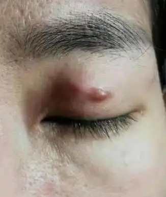 美女割双眼皮切出增生还留疤审核资质很重要