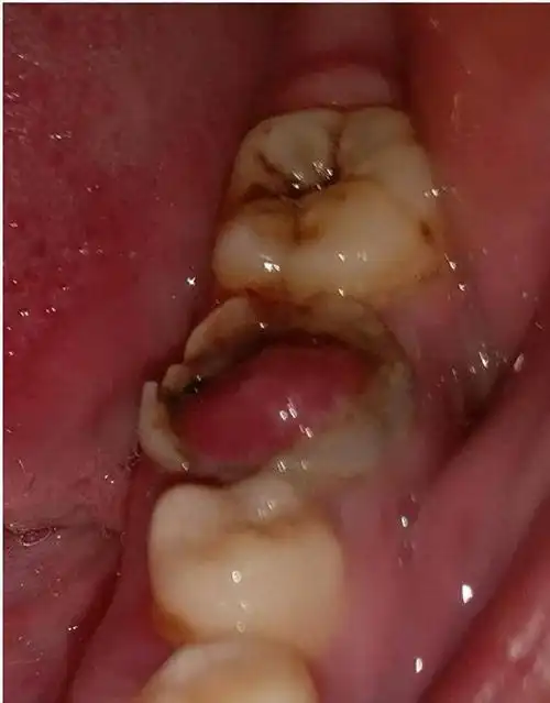 牙髓息肉怎么治疗?