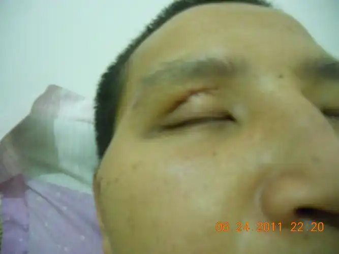 颧骨骨折手术后,一边高的很厉害,这样算手术失败吗?