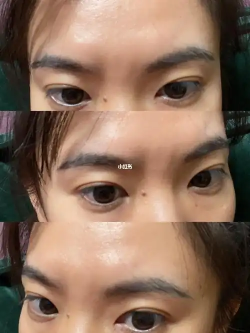 求问印堂眉心凹陷做什么医美呢