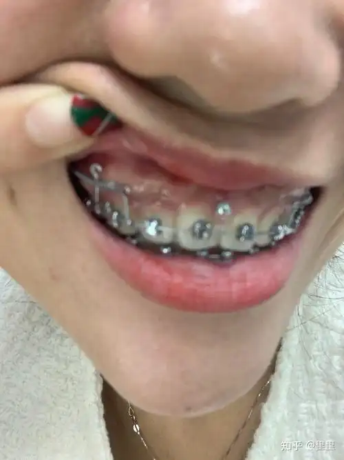 牙槽骨鼓包突出 - 知乎