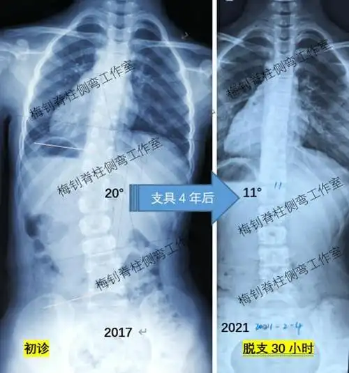 "生长期侧弯儿童"--穿戴支具反弹怎么办?