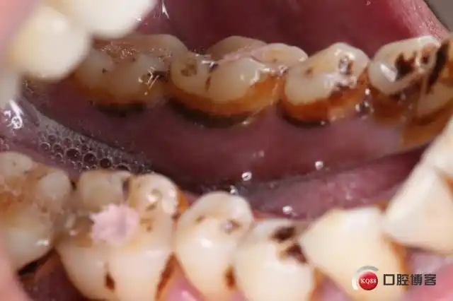 牙周脓肿病例-吴辰的博客-kq88口腔博客