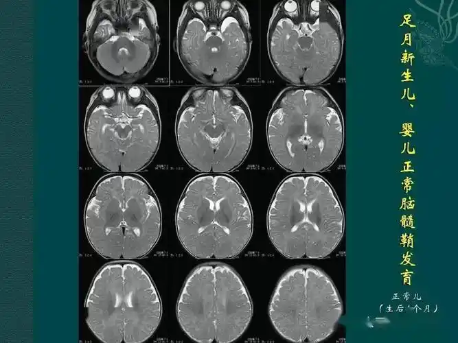 足月儿及婴儿神经系统发育mri