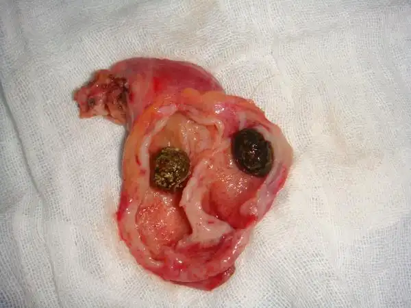 楼主sqw0072009-09-16 18:51:299月9日,为一例结石性胆囊炎病人施行lc