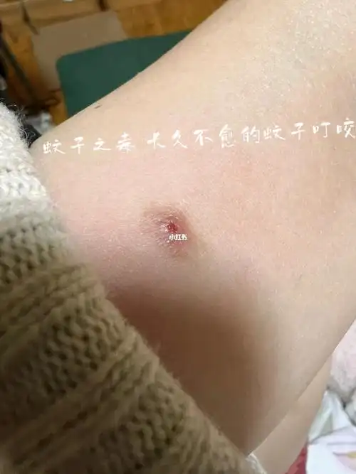 说说你被蚊子咬后最长多久好