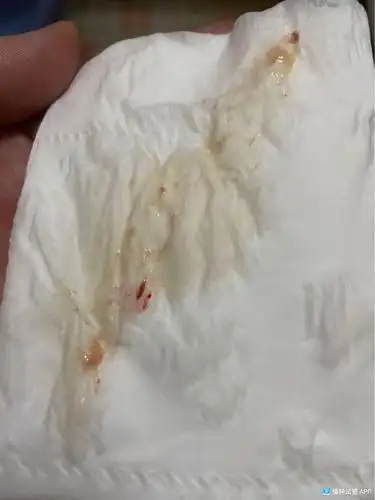 [试管婴儿]姐们们,移植冻囊胚第二天出的排