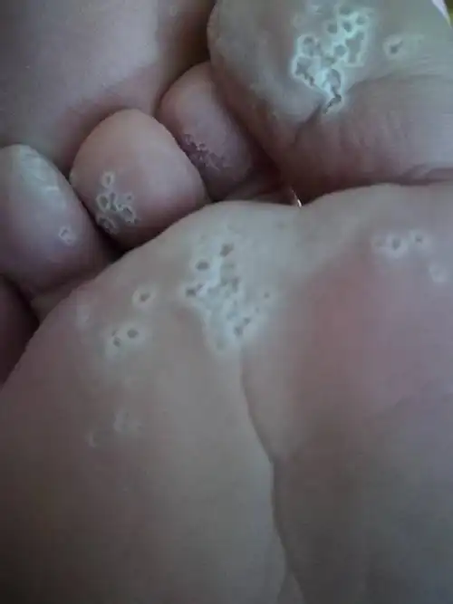 脚底下长了很多小洞洞 而且旁边是白的 有一段时间了