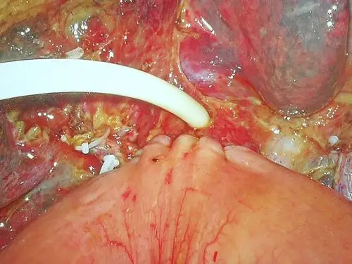 腹腔镜下胆肠roux-en-y吻合术技术要点 - 好大夫在线