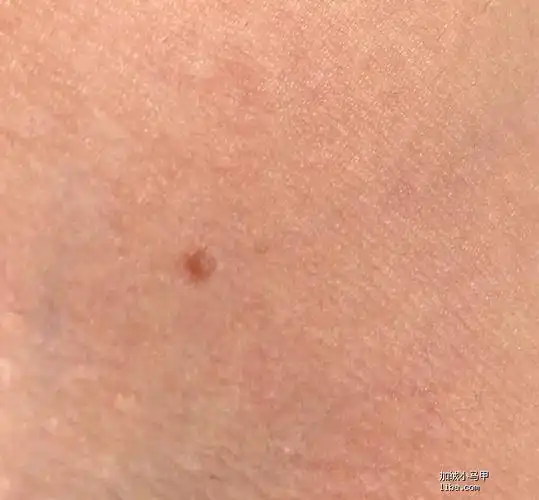 我这个长的小肉疙瘩是疣吗